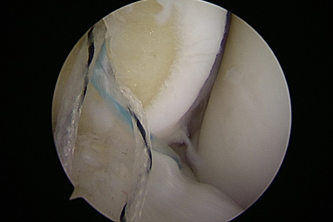 前距腓靭帯損傷 術中関節鏡視像（アンカー挿入時）