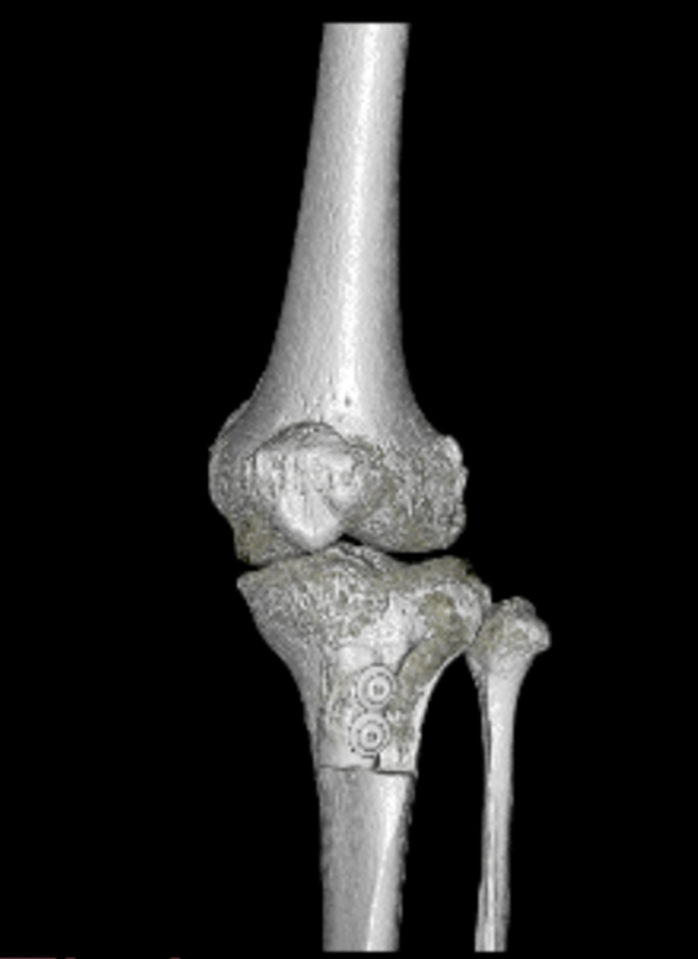 MPFL再建術＋脛骨粗面移行術　術後CT像
