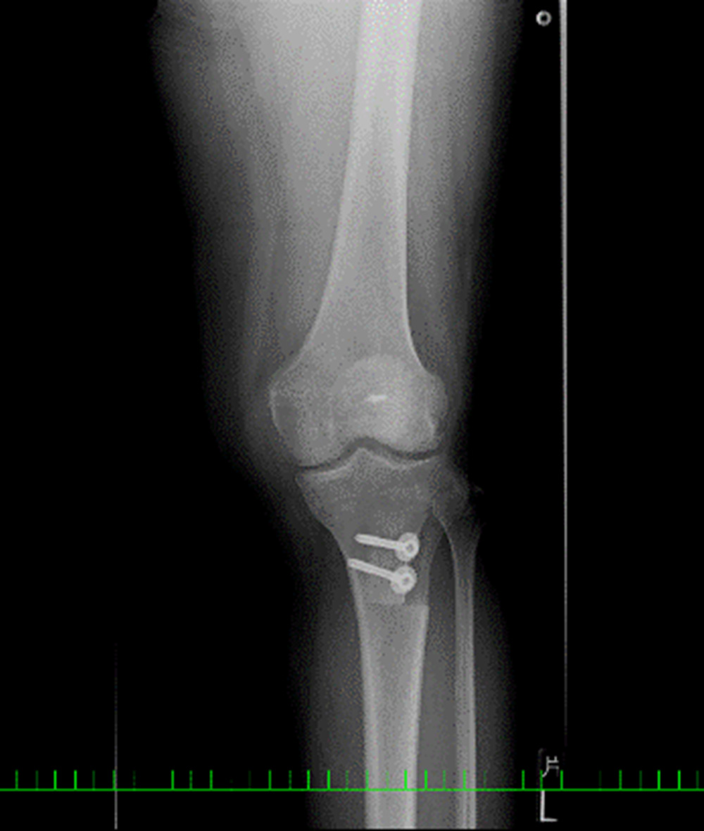 MPFL再建術＋脛骨粗面移行術　術後レントゲン像